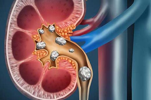 Kidney stones inside a kidney.